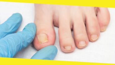 All You Need To Know About An Ingrown Toenail