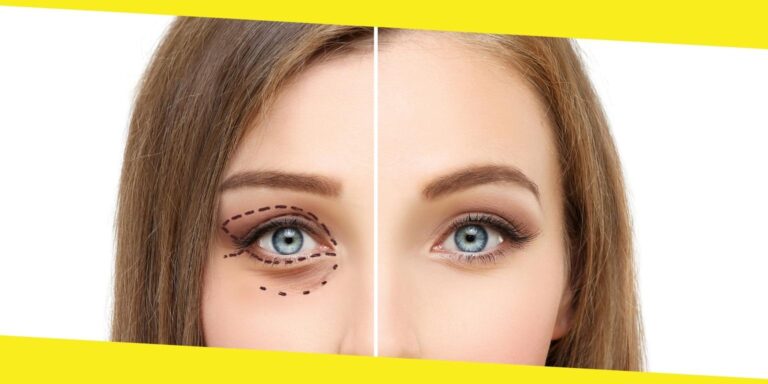 What is Blepharoplasty – What to Expect
