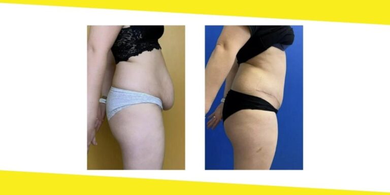 Is Overseas Cosmetic Surgery Worth the Risk?