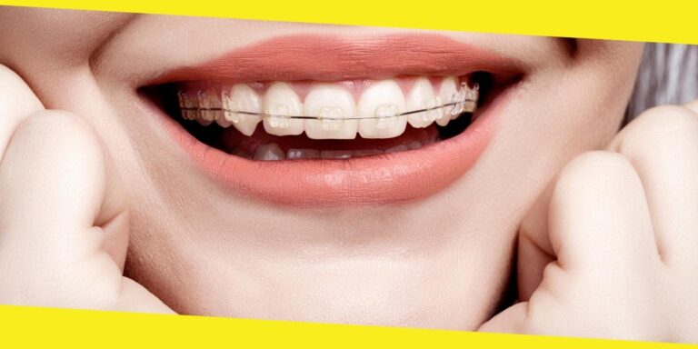 Top Reasons To Choose Invisalign Over Traditional Braces