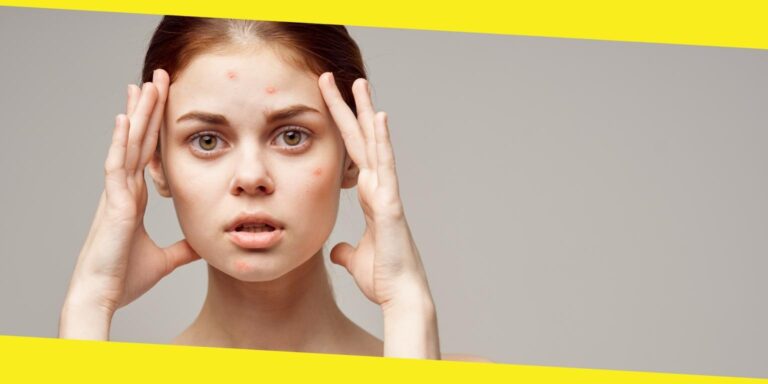 Learn About the Causes, Types, and Treatment Options Available for Acne