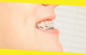 Types of Orthodontic Treatments You Need to Know About