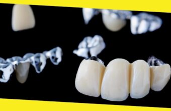 What Makes You a Good Candidate for Dental Bridges?