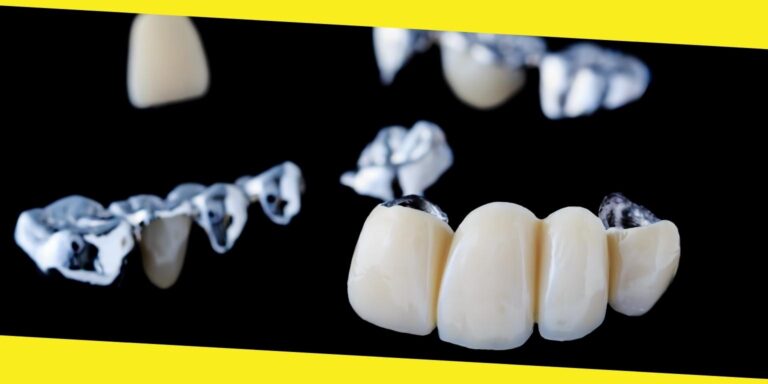 What Makes You a Good Candidate for Dental Bridges?