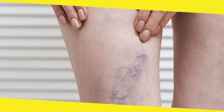 Premier Varicose Veins Care in Illinois