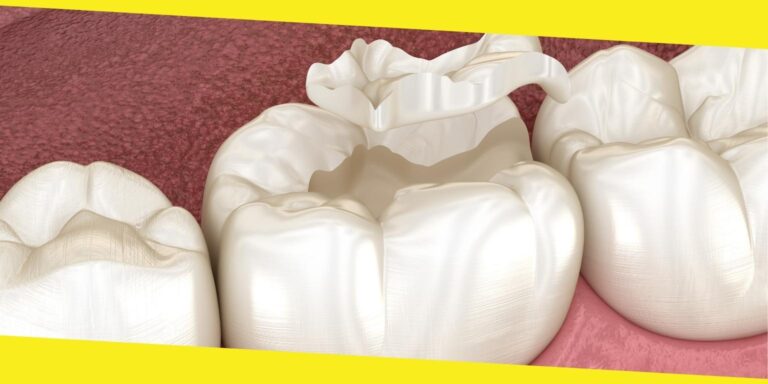 What Are Inlay Restorations?