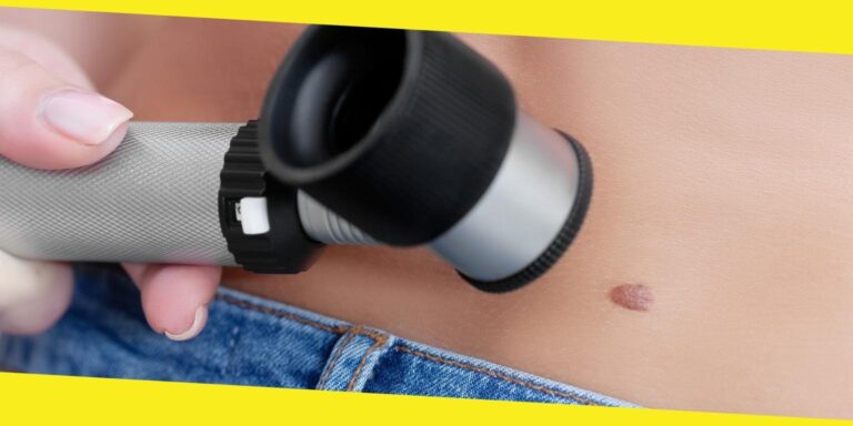 What You Should Know About Moles