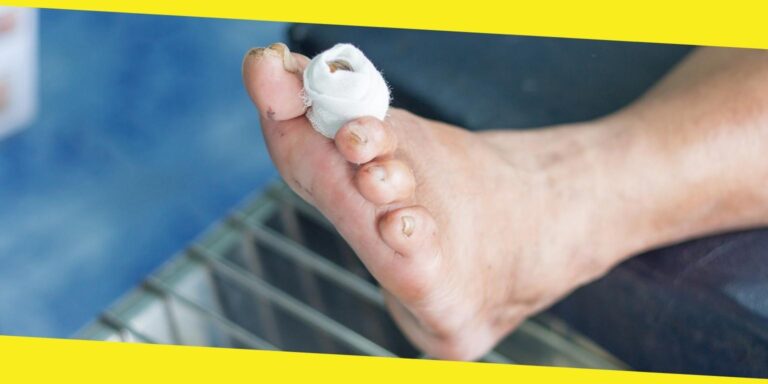 What are Diabetic Wounds?