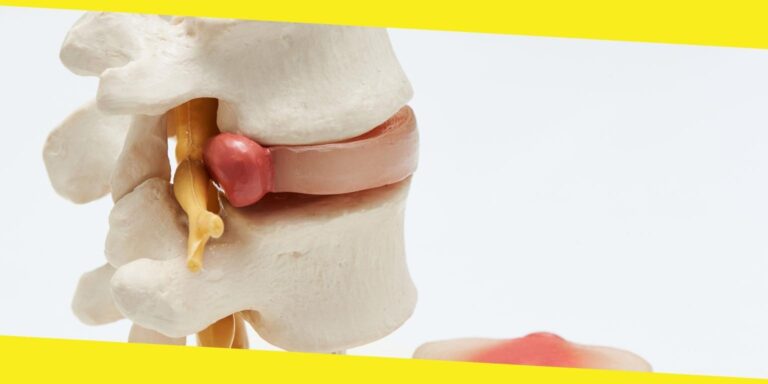 What to Expect After an Artificial Disc Surgery