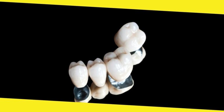 What You Ought to Know About Crowns and Bridges