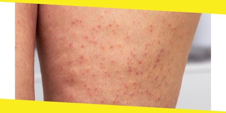 Factors that Increase Your Risk of Actinic Keratosis
