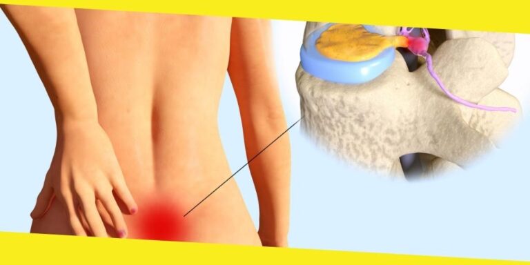 Everything You Should Know About Herniated Disc