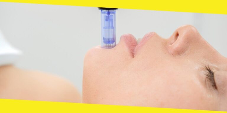Understanding the Benefits of Microneedling