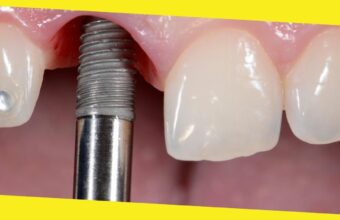 Why Are Dental Implants So Popular?