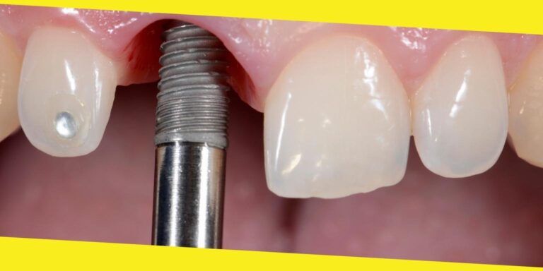 Why Are Dental Implants So Popular?