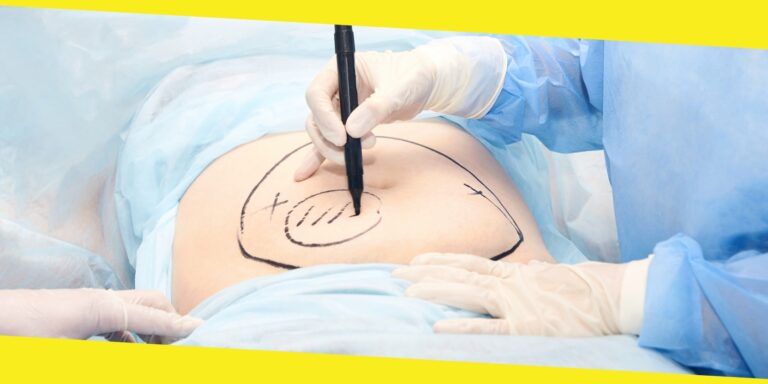 Everything You Should Know About Hysterectomy