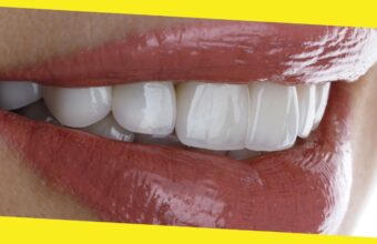 What to Know Before Getting Porcelain Veneers