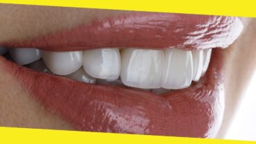 What to Know Before Getting Porcelain Veneers