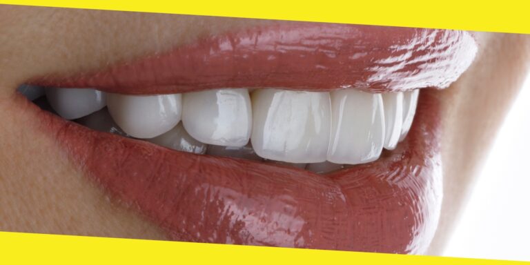 What to Know Before Getting Porcelain Veneers