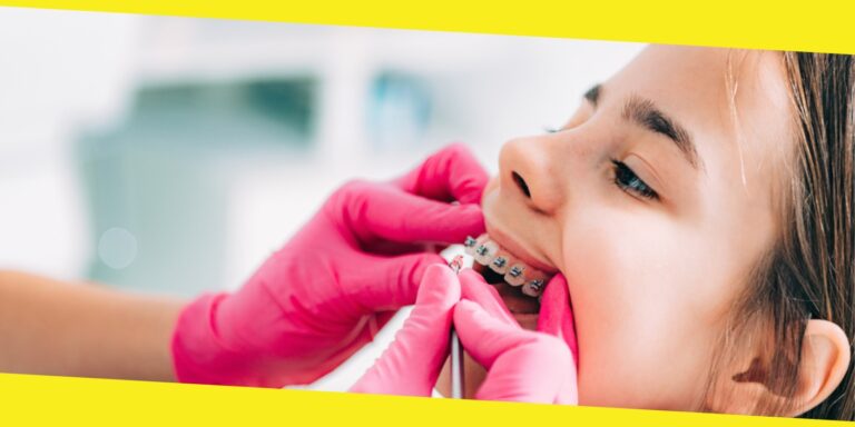 A Step-By-Step Guide To Getting Your Dental Braces