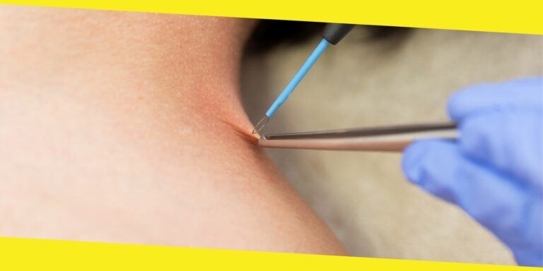 Treatment Options For Warts