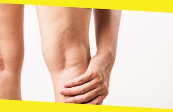 What are the Treatment Options for Spider Veins?