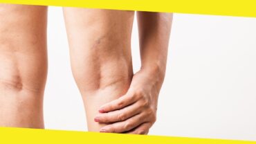 What are the Treatment Options for Spider Veins?