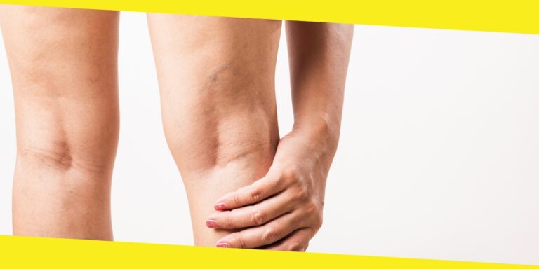 What are the Treatment Options for Spider Veins?