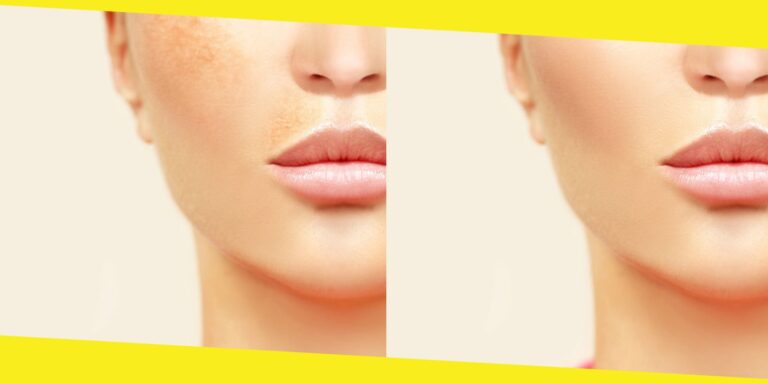 Hyperpigmentation: Everything You Need to Know