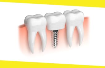 All-On-4 Dental Implants Procedure From Start To Finish