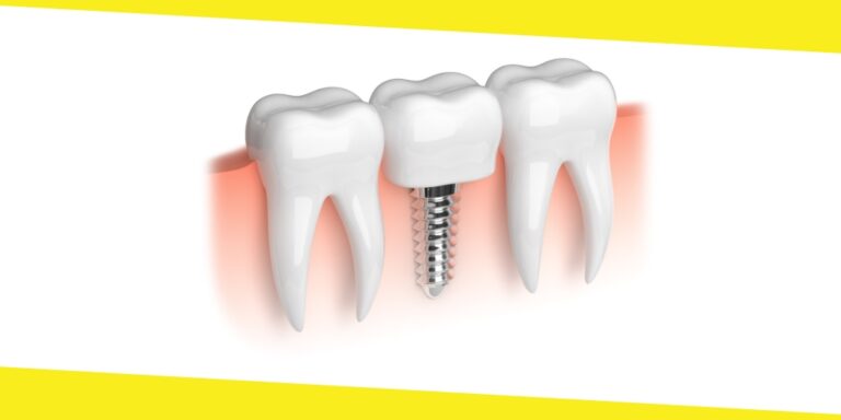 All-On-4 Dental Implants Procedure From Start To Finish