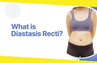 All You Need to Know About Diastasis Recti Repair