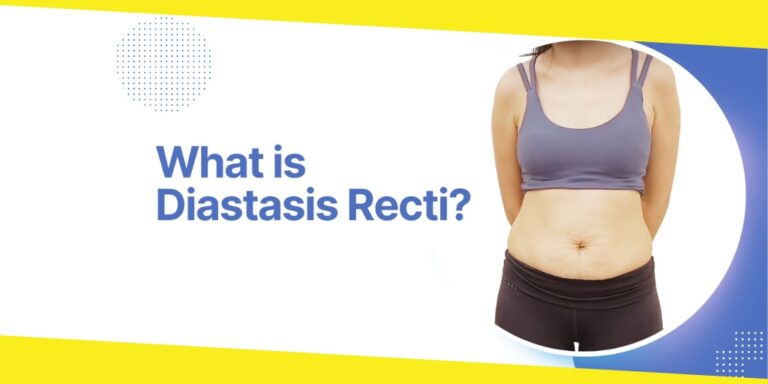 All You Need to Know About Diastasis Recti Repair