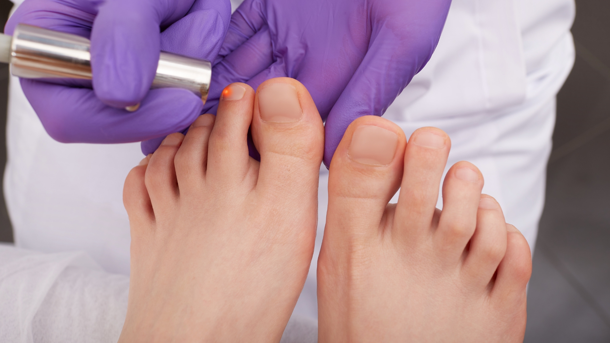 know-how-to-prevent-foot-and-toenail-fungus