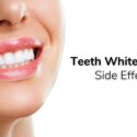Using the Teeth Whitening Kit: Are There Any Side Effects to Take Into Account?