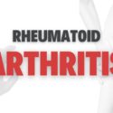 How to Treat Rheumatoid Arthritis Naturally?