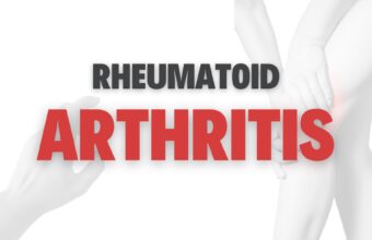 How to Treat Rheumatoid Arthritis Naturally?