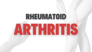 How to Treat Rheumatoid Arthritis Naturally?