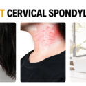 5 Effective Ways to Prevent/Treat Cervical Spondylosis