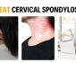 5 Effective Ways to Prevent/Treat Cervical Spondylosis