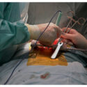 Optimizing Colorectal Surgery Recovery: Strategies for Long-Term Success