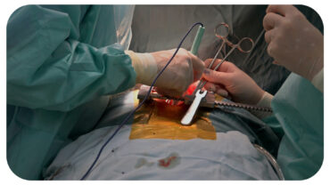 Optimizing Colorectal Surgery Recovery: Strategies for Long-Term Success