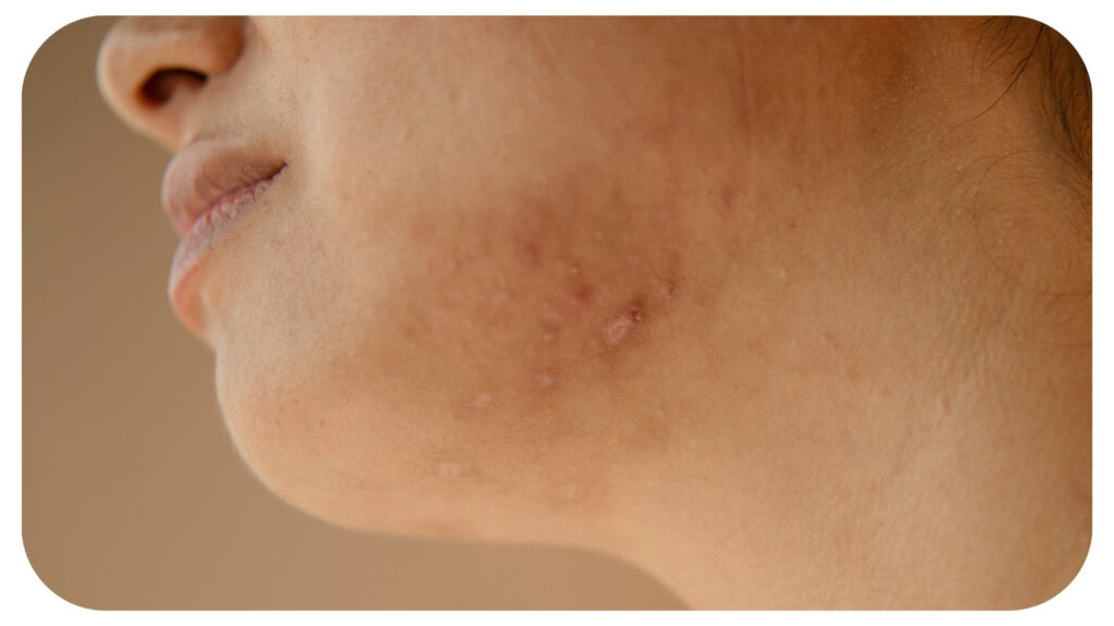 a woman with acne on her face.