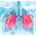 5 Diseases That Affect Your Lungs