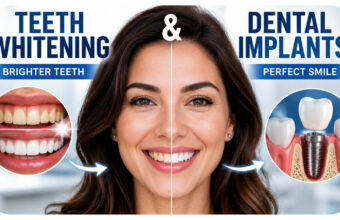 Why Teeth Whitening Often Complements Dental Implant Treatment Plans