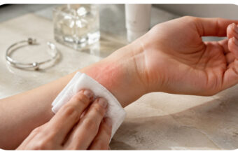 Treating Contact Dermatitis: Pro Tips for Rapid Relief