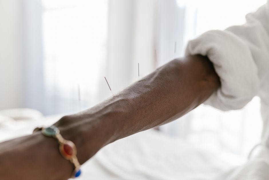 Close-up of acupuncture needles inserted into a person's arm during a complementary therapy session for pain management and holistic recovery.